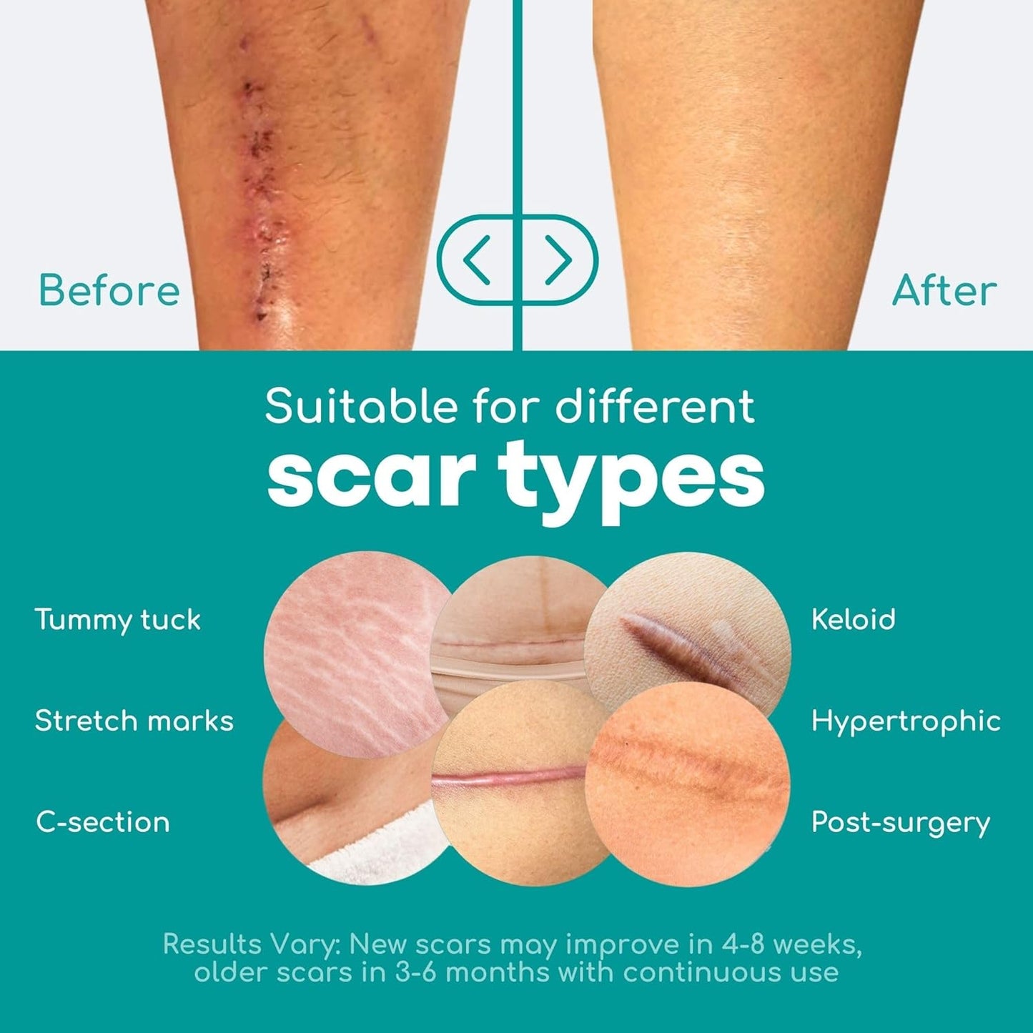 Silicone Scar Tape