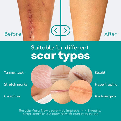 Silicone Scar Tape
